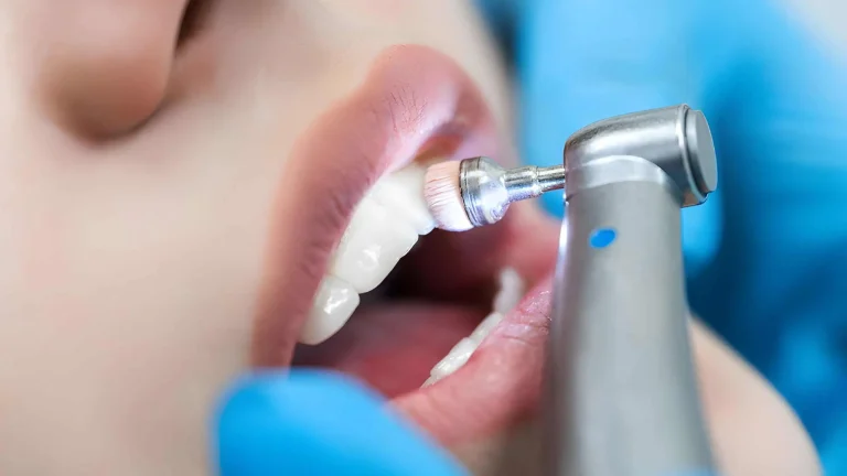 Причины доверить чистку зубов опытным профессионалам